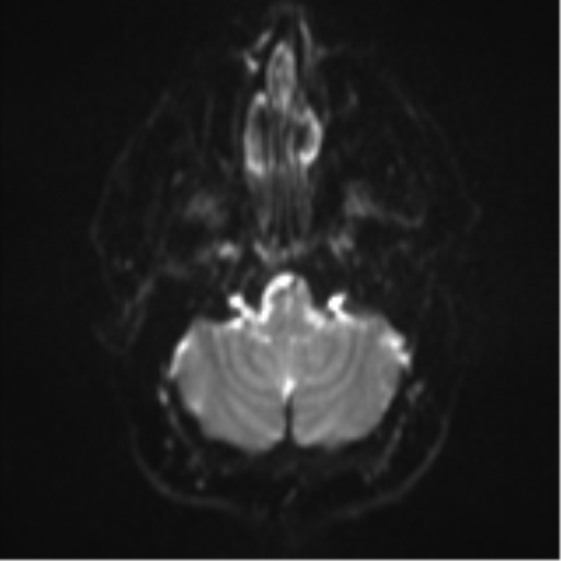 File:Colloid cyst (Radiopaedia 53164-59125 Axial DWI 5).png