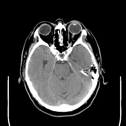 File:Colloid cyst (large) (Radiopaedia 34415-35734 Axial non-contrast 21).png