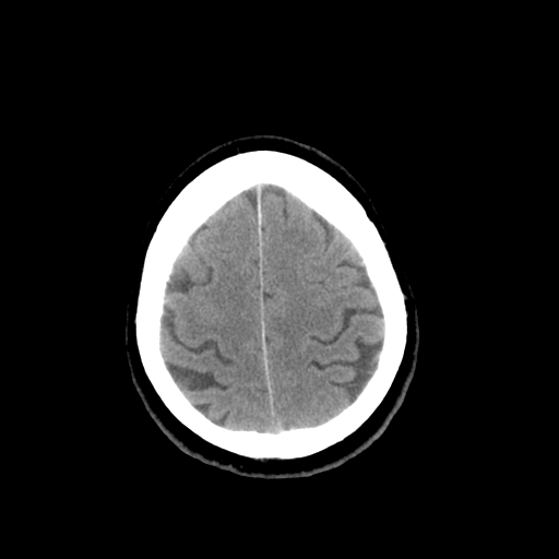 File:Colloid cyst (large) (Radiopaedia 34415-35734 Axial non-contrast 48).png