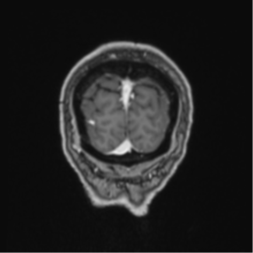 File:Colloid cyst of the third ventricle (Radiopaedia 86571-102662 Coronal T1 C+ 10).png