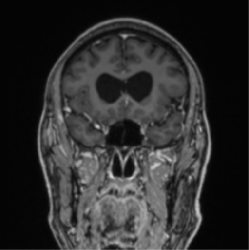 File:Colloid cyst of the third ventricle (Radiopaedia 86571-102662 Coronal T1 C+ 64).png