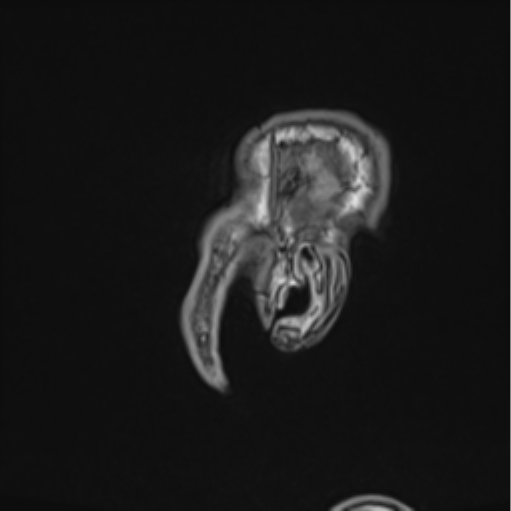 File:Colloid cyst of the third ventricle (Radiopaedia 86571-102662 Sagittal T1 3).png