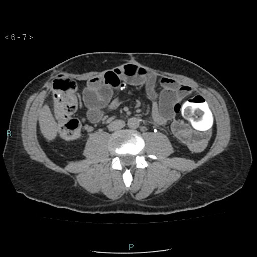 File:Colo-cutaneous fistula (Radiopaedia 40531-43129 A 2).jpg