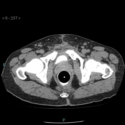 Colo-cutaneous fistula (Radiopaedia 40531-43129 A 99).jpg