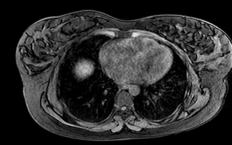 File:Colon adenocarcinoma with Krukenberg tumors, advanced pregnancy (Radiopaedia 67279-76645 A 81).jpg