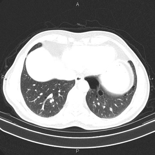File:Colon cancer (Radiopaedia 85663-101443 Axial lung window 49).jpg