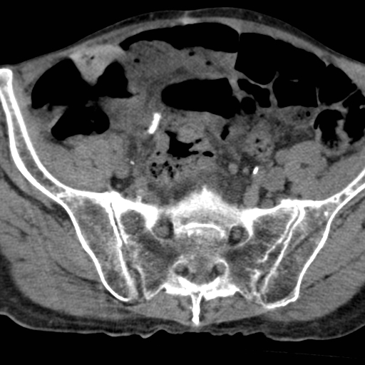 Colon cancer with calcified liver metastasis (Radiopaedia 74423-85309 Axial non-contrast 88).jpg