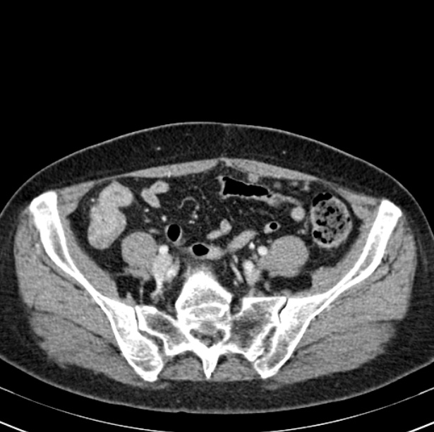 Colon carcinoma with hepatic metastases (Radiopaedia 29477-29961 A 85).jpg