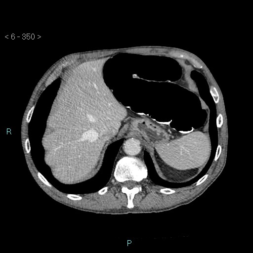 File:Colonic cancer (ultrasound and TC imaging) (Radiopaedia 50346-55713 B 350).jpg