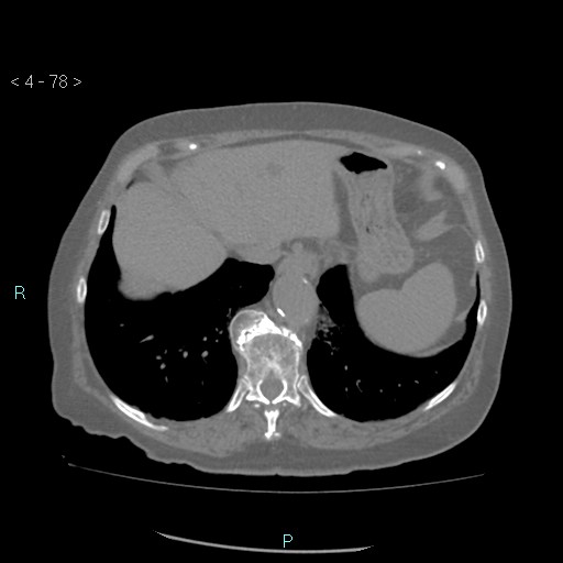 Colonic lipomas (Radiopaedia 49137-54244 Axial bone window 36).jpg