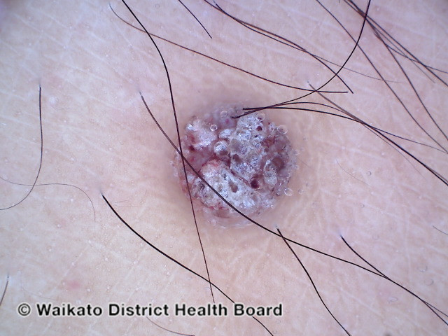 File:Dermoscopy of angiokeratoma of Fordyce on vulva (DermNet NZ angiokeratoma-47).jpg