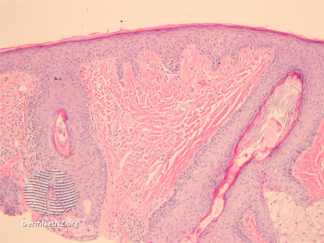 File:Figure 1 (DermNet NZ pathology-e-angiofibroma-figure-1).jpg