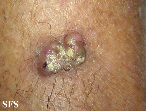 File:Keratoacanthoma (Dermatology Atlas 24).jpg