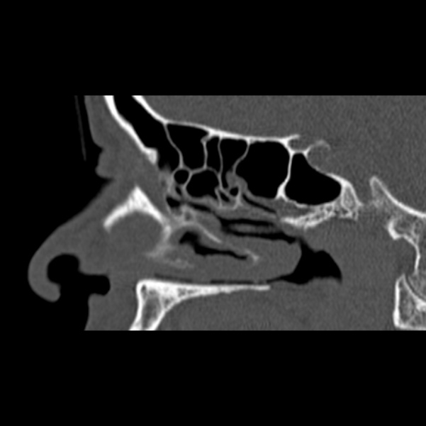 Nasal septal perforation (Radiopaedia 25030-25289 Sagittal bone window 15).jpg