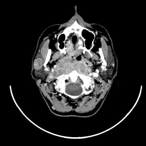 File:Nasopharyngeal carcinoma - infiltrating the clivus (Radiopaedia 62583-70875 Axial Post contrast 21).jpg
