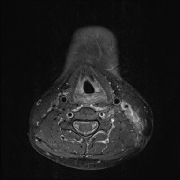 Nasopharyngeal carcinoma with skull base invasion (Radiopaedia 53415-59485 Axial T1 C+ fat sat 55).jpg