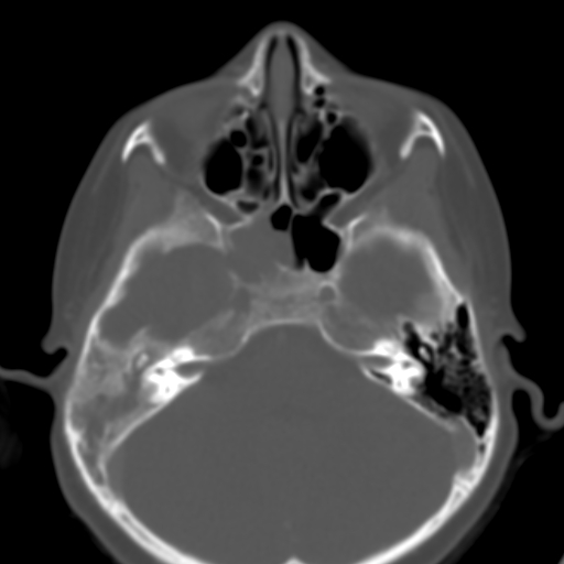 File:Nasopharyngeal rhabdomyosarcoma (Radiopaedia 23417-23491 Axial bone window 12).jpg