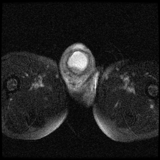 File:Necrotizing epididymo-orchitis with intra-testicular abscess (Radiopaedia 29397-29860 Axial T2 fat sat 14).jpg
