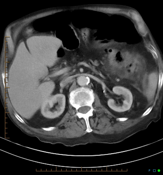 Necrotzing fasciitis due to a perforated adenocarcinoma of the splenic flexure (Radiopaedia 46930-51455 A 26).jpg