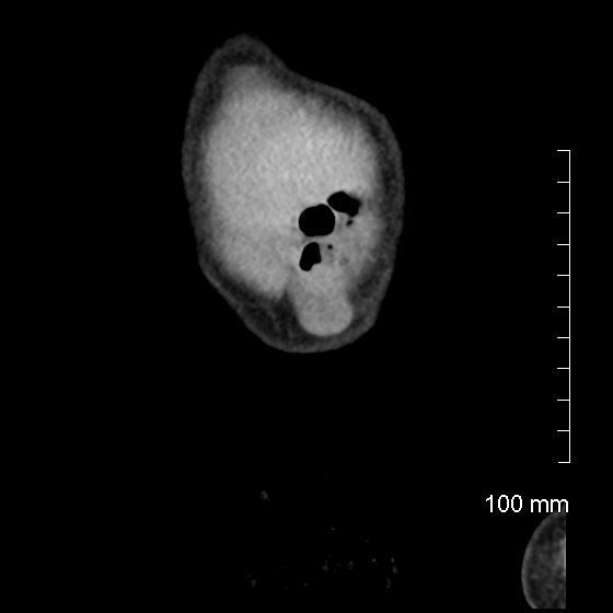 File:Neonatal neuroblastoma (Radiopaedia 56651-63438 Coronal non-contrast 4).jpg