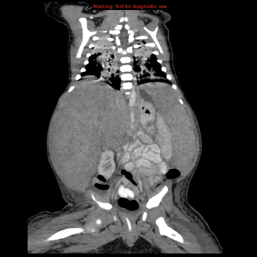 File:Neonatal neuroblastoma (Radiopaedia 9564-10223 B 82).jpg