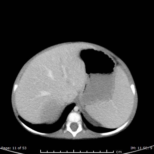 Nephroblastomatosis (Radiopaedia 41934-44935 A 11).jpg