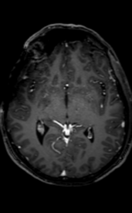 Neuro-Behçet disease (Radiopaedia 90112-107294 Axial T1 C+ 135).jpg