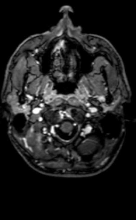 Neuro-Behçet disease (Radiopaedia 90112-107294 Axial T1 C+ 197).jpg