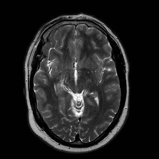 File:Neuro-Behcet's disease (Radiopaedia 21557-21506 Axial T2 13).jpg