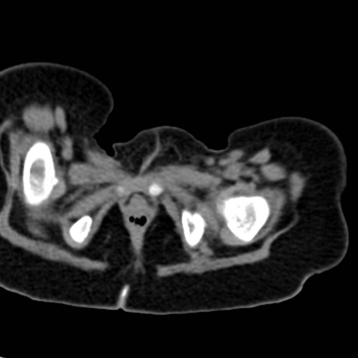 Neuroblastoma with skull metastases (Radiopaedia 30326-30960 Axial non-contrast 64).jpg