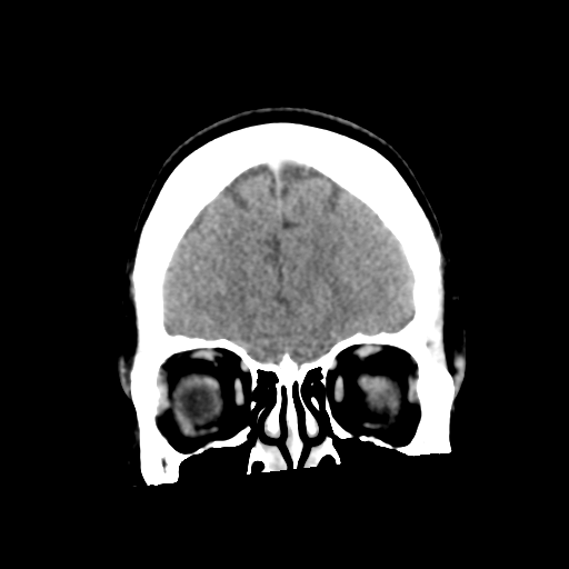 Neurocysticercosis - granular nodular (Radiopaedia 42786-45957 Coronal C+ 13).png