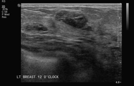 File:Neurofibromatosis of breast (Radiopaedia 5921-7462 A 1).jpg