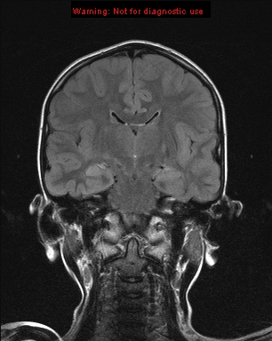 File:Neurofibromatosis type 1 with optic nerve glioma (Radiopaedia 16288-15965 Coronal FLAIR 12).jpg