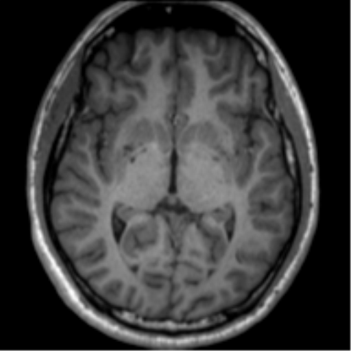 File:Neurofibromatosis type 2 (Radiopaedia 44936-48838 Axial T1 67).png