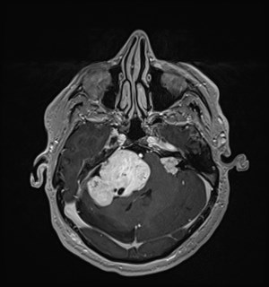 Neurofibromatosis type 2 (Radiopaedia 79097-92049 Axial T1 C+ 60).jpg