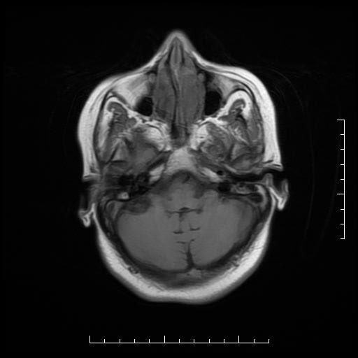 File:Neuroglial cyst of brainstem (Radiopaedia 29134-29526 Axial T1 4).jpg