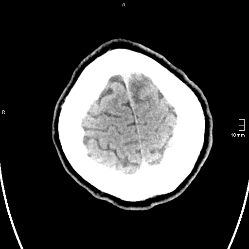File:Neurotoxoplasmosis - concentric target sign (Radiopaedia 70644-80783 Axial non-contrast 36).jpg