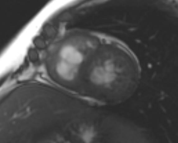 File:Non-compaction of the left ventricle (Radiopaedia 69436-79314 Short axis cine 107).jpg