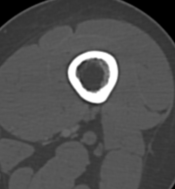 Non-ossifying fibroma - femur (Radiopaedia 82786-97042 Axial bone window 24).jpg