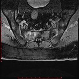 Non Hodgkin's lymphoma with metastasis to spine (Radiopaedia 54844-61103 Axial T1 C+ fat sat 37).jpg