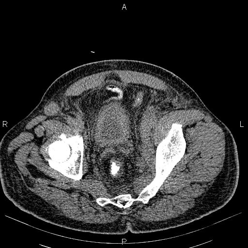 File:Non Hodgkin lymphoma in a patient with ankylosing spondylitis (Radiopaedia 84323-99621 Axial non-contrast 56).jpg