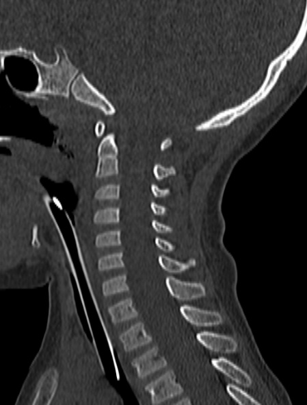 Normal CT cervical spine - pediatric (Radiopaedia 52549-58462 Sagittal bone window 95).jpg