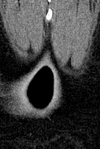 Normal CT lumbar spine (Radiopaedia 53981-60118 F 109).jpg