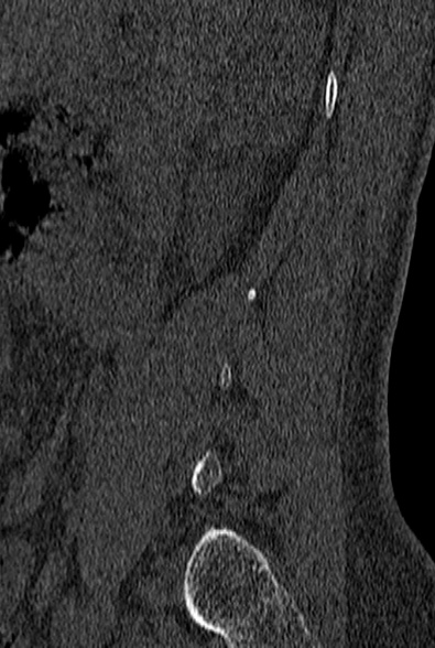 File:Normal CT lumbar spine (Radiopaedia 53981-60118 Sagittal bone window 6).jpg
