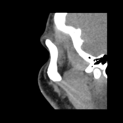 Normal CT paranasal sinuses (Radiopaedia 42286-45390 F 24).jpg