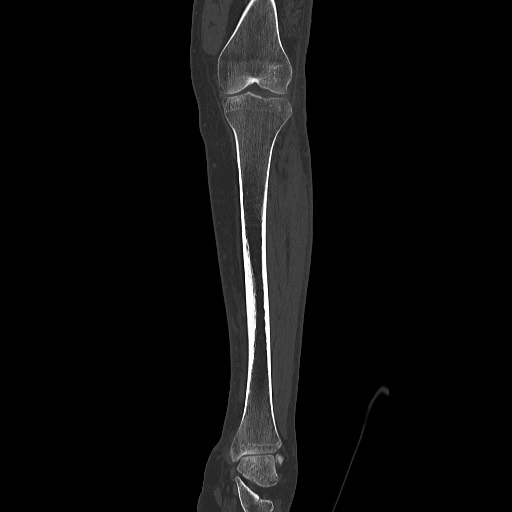 Normal CT tibia and fibula (Radiopaedia 51195-56848 Coronal non-contrast 32).jpg