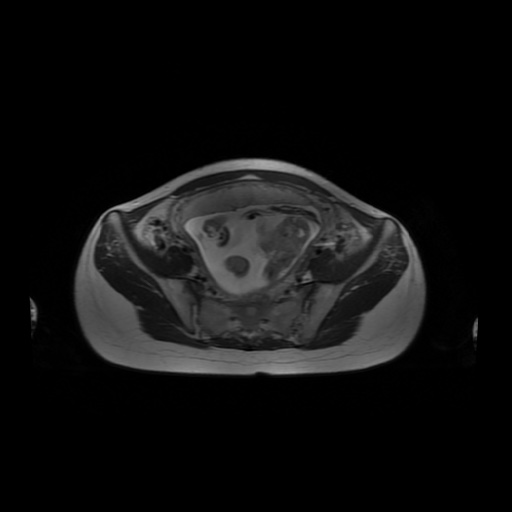 File:Normal MRI abdomen in pregnancy (Radiopaedia 88001-104541 Axial T2 53).jpg