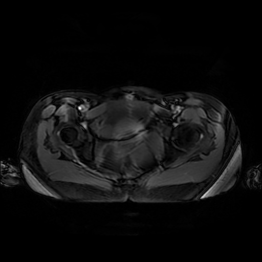 File:Normal MRI abdomen in pregnancy (Radiopaedia 88001-104541 D 55).jpg