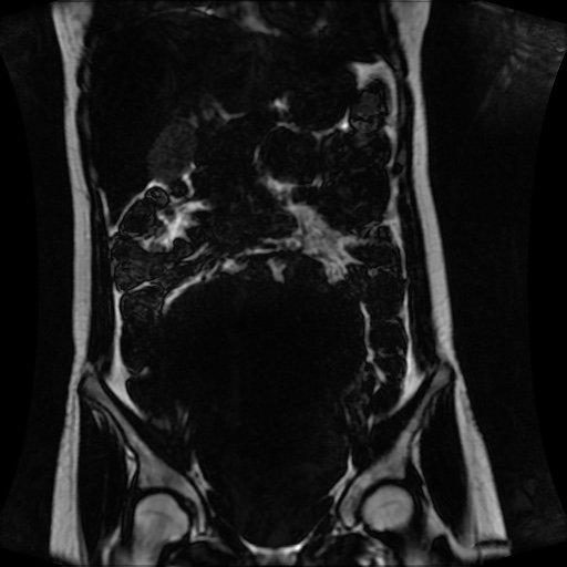 Normal MRI abdomen in pregnancy (Radiopaedia 88001-104541 N 62).jpg
