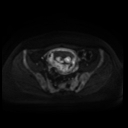 Normal MRI abdomen in pregnancy (Radiopaedia 88005-104548 Axial DWI 95).jpg